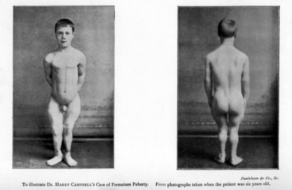 photographs of a Victorian boy with unusually strong muscular development